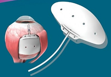 Qlaukoma İmplantı Klapansız